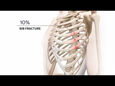 Видео: Лечение острых и хронических переломов ребер