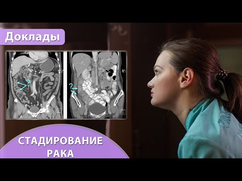 Видео: Роль компьютерной томографии в стадировании рака ободочной кишки. Екатерина Кульпина