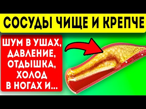 Видео: Шум в ушах прошел, а все потому, что… Чистка сосудов, сердце, инфаркт, инсульт! Про здоровье!