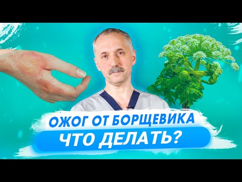 Видео: Химический ожог соком борщевика - как лечить? / Доктор Виктор
