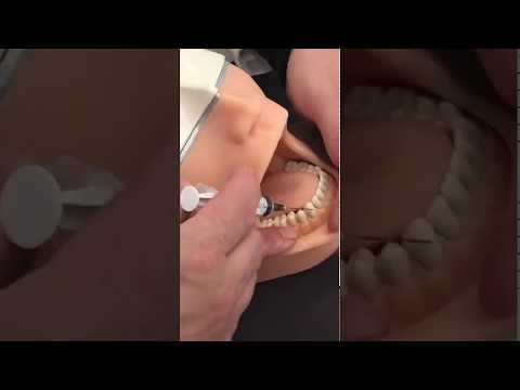 Видео: Ментальная анестезия. Анестезии в стоматологии.