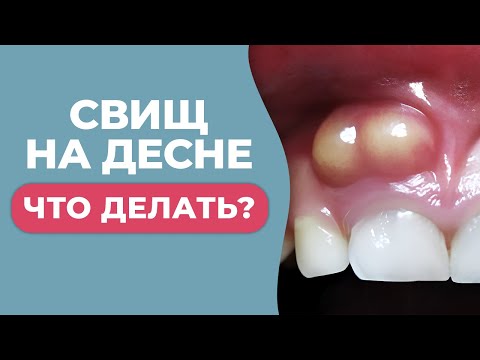 Видео: ЧЕМ ОПАСНА ШИШКА НА ДЕСНЕ И КАК БЫСТРО ОТ НЕЕ ИЗБАВИТЬСЯ?
