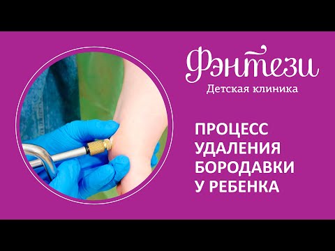 Видео: 🔎  Процесс удаления бородавки у ребенка