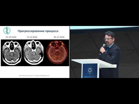 Видео: Меланома. Разбор клинических случаев. Кл. случай 4