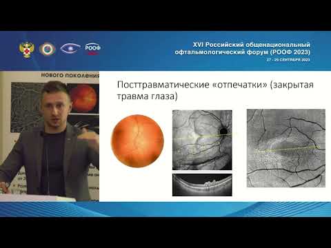 Видео: «Отпечатки пальцев» внутри глаза