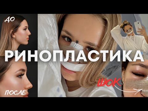 Видео: РИНОПЛАСТИКА: весь процесс ДО и ПОСЛЕ l МОЯ ИСТОРИЯ | я пожалела? | VLOG МОСКВА