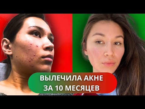 Видео: Как я вылечила АКНЕ? Прыщи это не навсегда! Мои ошибки в лечении + аптечные средства