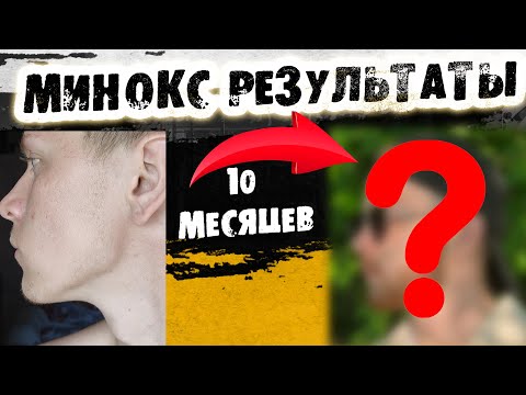 Видео: Как запустить рост бороды с нуля / Курс Минокса 10 месяцев / Выпуск 33 / Андрей борода