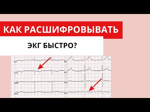 Видео: Как быстро расшифровывать ЭКГ? (алгоритм быстрой расшифровки)