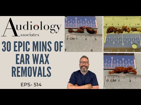 Видео: 30 МИНУТ УДАЛЕНИЯ УШНОЙ СЕРЫ - EP514