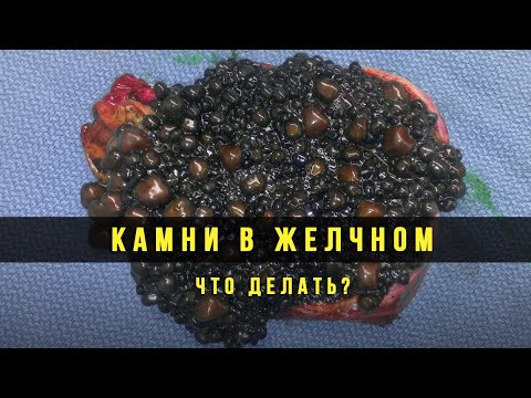 Видео: Как образуются камни в желчном пузыре и Как избежать этой проблемы, пока она вас не коснулась