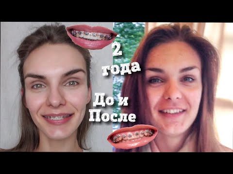 Видео: Брекеты 2 года | До и После | Как прикус меняет лицо |