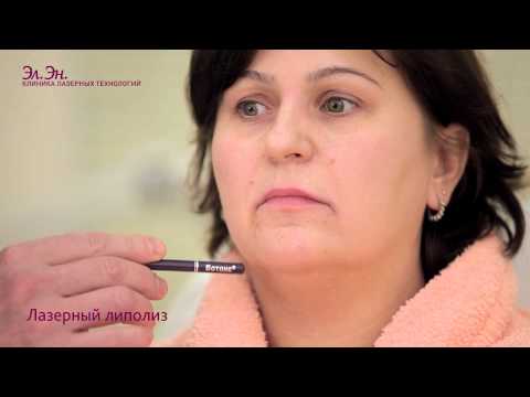 Видео: Лазерный липолиз на аппарате SmartLipo (DEKA) Италия