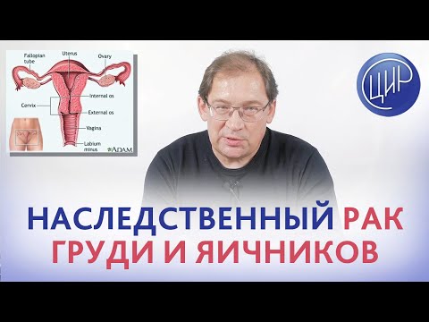 Видео: РАК ЯИЧНИКОВ: как ВЫЯВИТЬ ПРЕДРАСПОЛОЖЕННОСТЬ. Как распознать рак яичников на ранней стадии.
