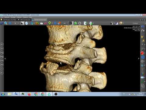 Видео: КОМПРЕССИОННЫЙ  ПЕРЕЛОМ  Л2  ПОЗВОНКА