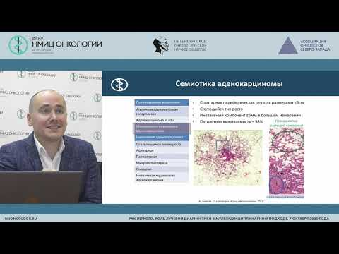 Видео: Субсолидный очаг в легком-дифференциально-диагностический ряд