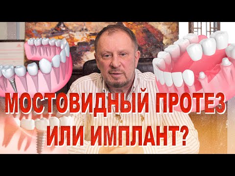 Видео: Мост или имплант?