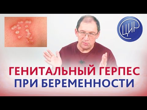 Видео: Генитальный герпес, обострение при беременности. Влияние на плод.