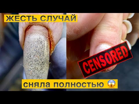 Видео: СИЛЬНАЯ ТРАВМА НОГТЯ 😰Что делать мастеру??