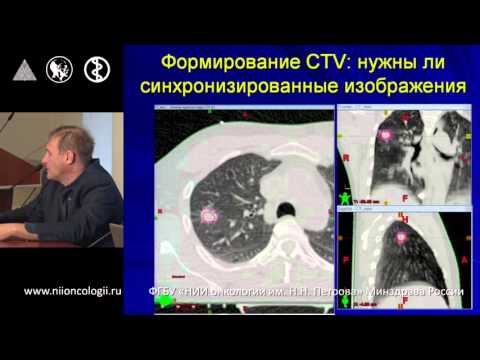 Видео: Стереотаксическая лучевая терапия. Новиков С.Н. Часть 1