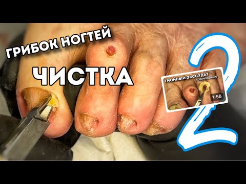 Видео: Облегчить состояние при запущенном онихомикозе. Динамика гнойной мозоли. Часть-2