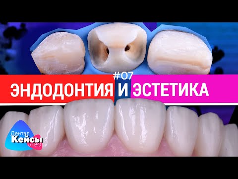 Видео: Эндодонтия и эстетика. #07