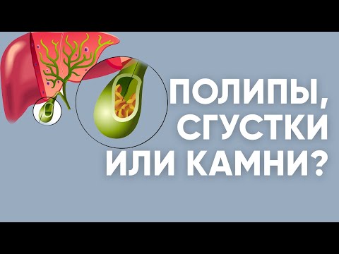 Видео: Полипы, сгустки или камни? | Доктор Ирина Мироновна