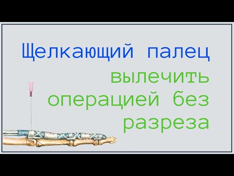 Видео: Как вылечить щелкающий палец без разреза? Результат сразу на столе. В этом видео.