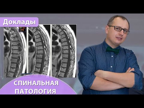 Видео: Интерактивные случаи спинальной патологии с обсуждением. Андрей Мангов