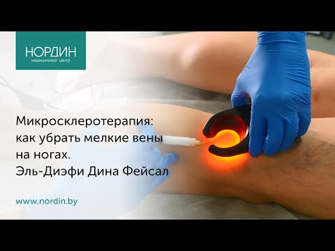 Видео: Микросклеротерапия сосудистых сеточек