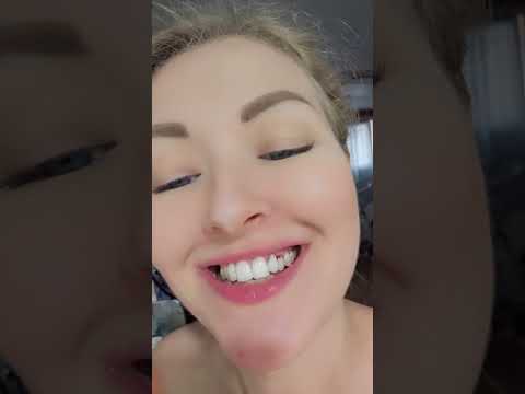 Видео: 126. Рассказываю как исправила два зуба в Корее.