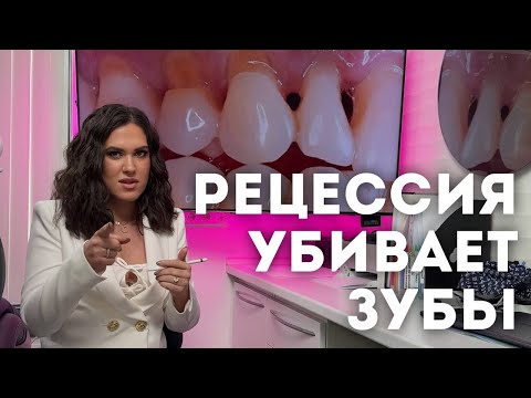 Видео: Рецессия (опущение) десны — причины и как с этим бороться. Клиновидный дефект не то, чем кажется