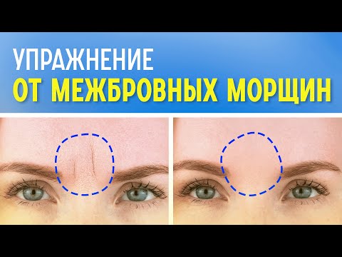 Видео: Как убрать межбровную морщину навсегда
