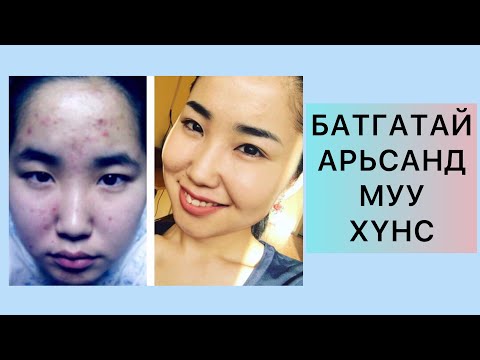 Видео: Worst Foods For Acne | Батгатай арьсанд муу хүнс