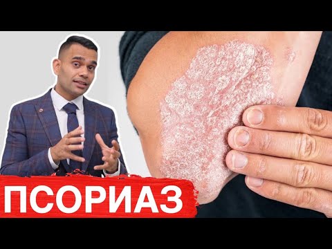 Видео: 2 Лучших Средства Для Лечения Псориаза - Лечение Псориаза | Доктор Вивек Джоши