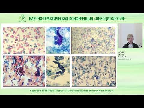 Видео: Скрининг рака шейки матки в Гомельской области Республики Беларусь