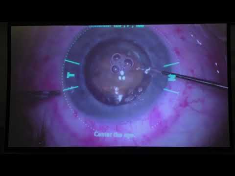 Видео: Фемтолазер ассистированная ультразвуковая факоэмульсификация с имплантацией торической ИОЛ AcrySof I