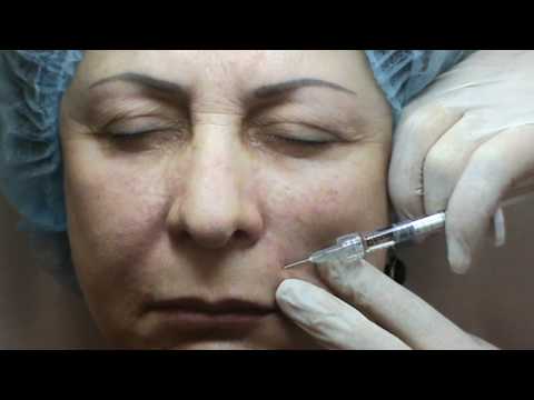 Видео: Princess Volume, докоррекция спустя некоторое время