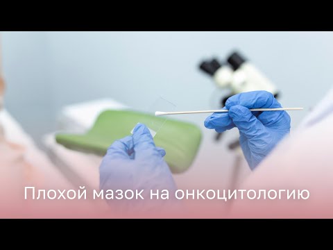 Видео: 🧫 Плохой мазок на онкоцитологию: что показывает и как обследовать?