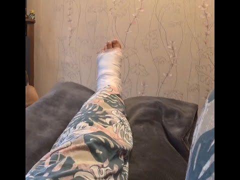 Видео: Ожог стопы 2-ой степени/ Чем лечу