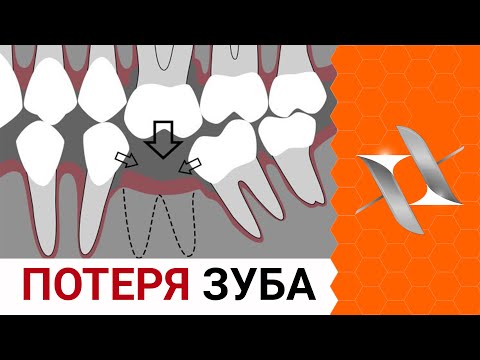 Видео: Что делать если удалили зуб? | Нужен ли имплантат?