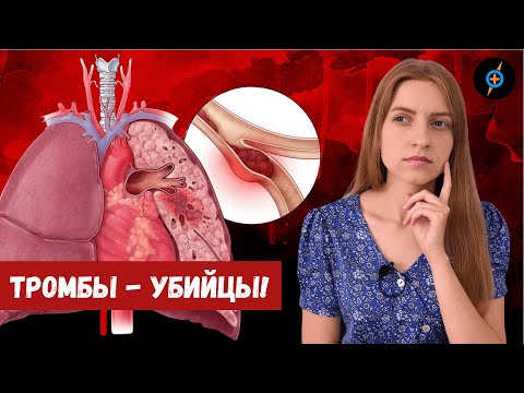 Видео: Все о ТЭЛА (тромбоэмболии легочной артерии) - причины, признаки, симптомы, прогноз | Mednavigator.ru