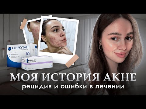 Видео: Рецидив акне спустя 3 года: какие ошибки привели к повторному лечению?