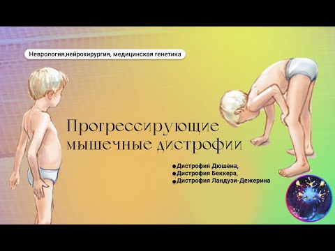 Видео: Прогрессирующие мышечные дистрофии