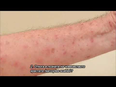Видео: Скабиес -  симптоми и терапия