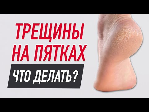 Видео: ✅ ЧТО ДЕЛАТЬ С ТРЕЩИНАМИ НА ПЯТКАХ? | Алёна Шутова | Учебный центр BBALANCE
