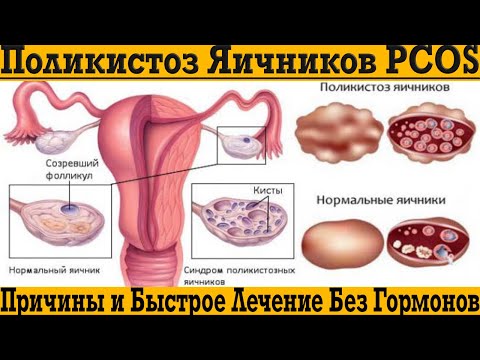 Видео: Поликистоз яичников! Быстрое лечение без гормонов и причины возникновения!