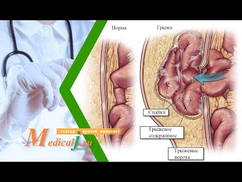 Видео: Грыжа передней брюшной стенки. Какие причины? Какие симптомы? Как лечить?