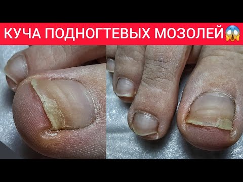 Видео: 😱УБИРАЮ МОЗОЛЬ ПУШЕРОМ 🤦‍♀️😳 АППАРАТНЫЙ ПЕДИКЮР ❤