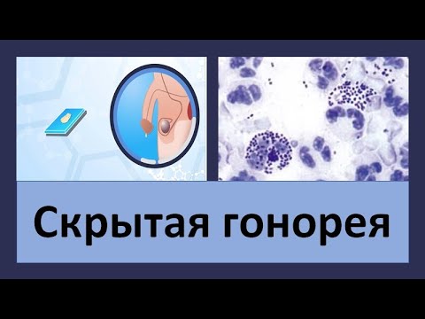 Видео: Скрытая гонорея